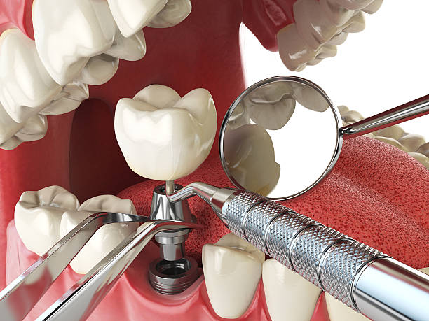 Best Emergency Dentist for Knocked-Out Tooth in Owings, MD